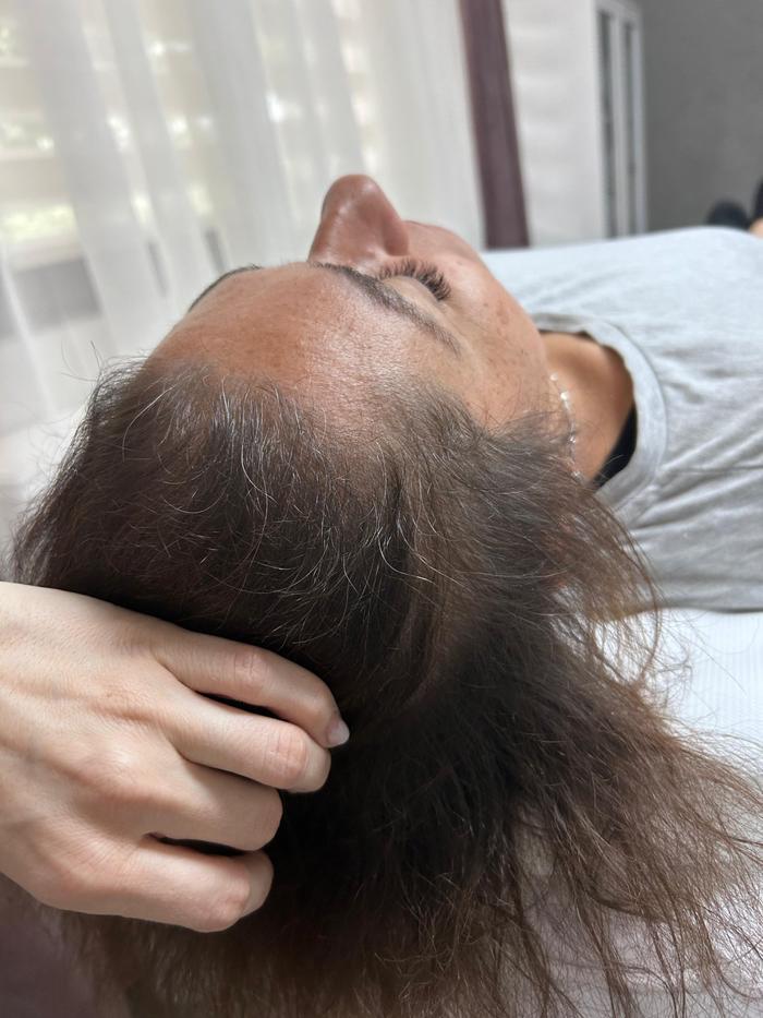 Alopecie androgenică feminină Rarefiere avansată — zone frontale cabinet TRICOEXPERT Iași