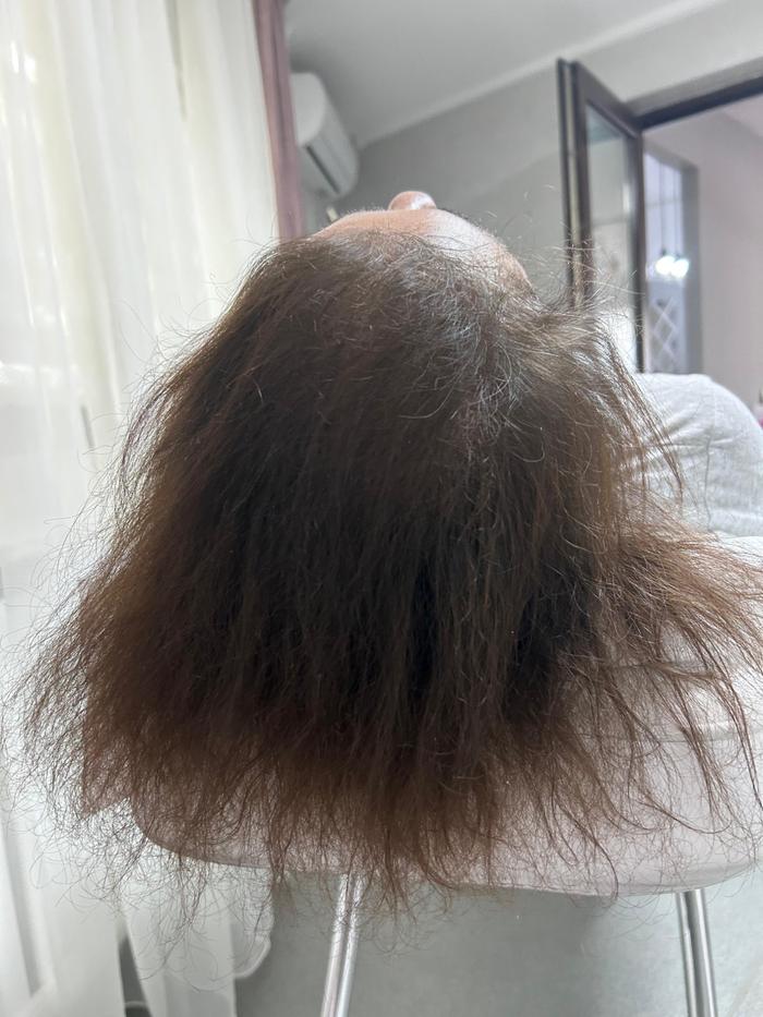 Alopecie androgenică feminină Vertex — densitate scăzută, vedere completă cabinet TRICOEXPERT Iași