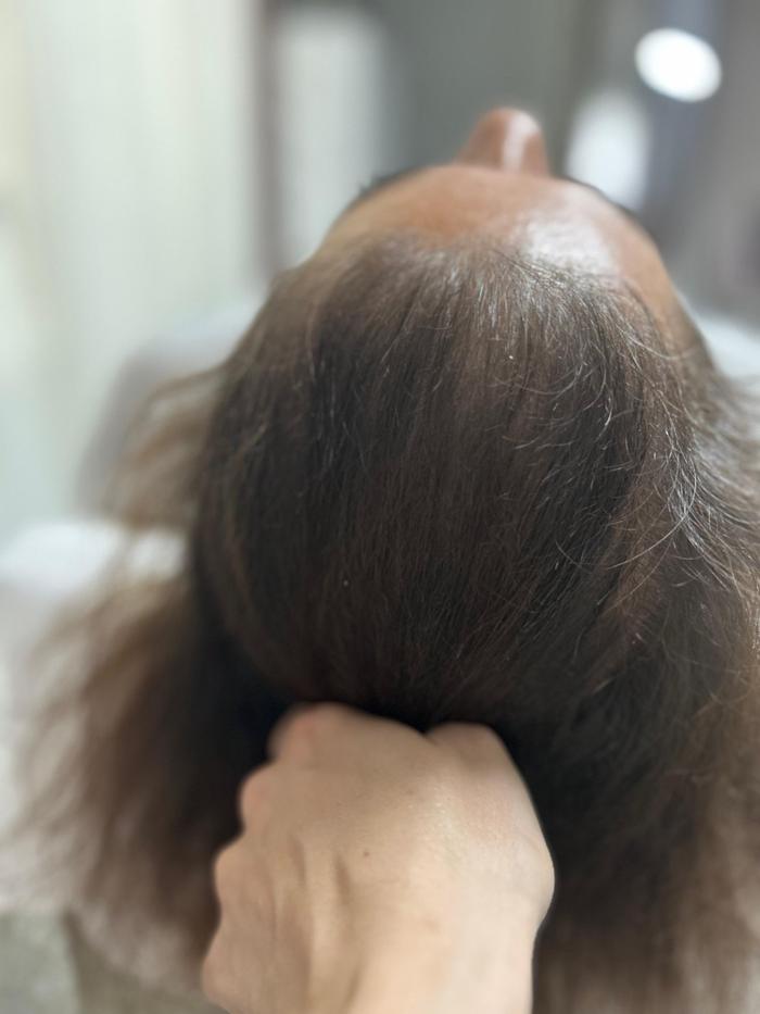 Alopecie androgenică feminină Linia frontală — retrasă bilateral cabinet TRICOEXPERT Iași