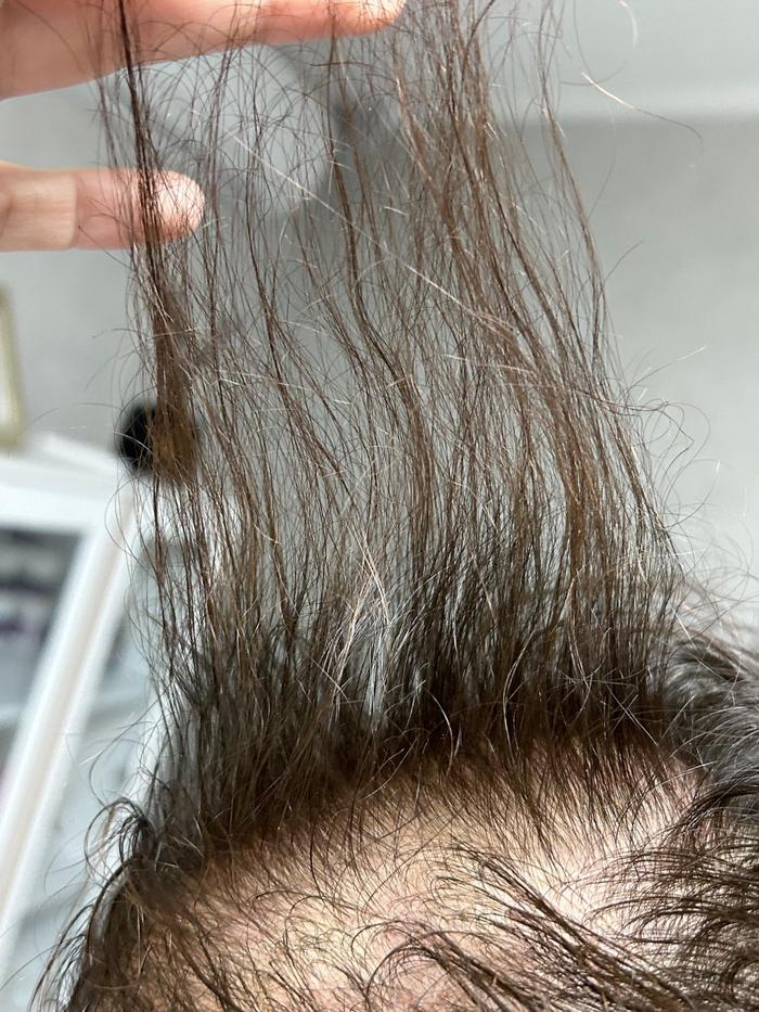Alopecie androgenică feminină Vedere generală — rarefiere difuză vertex cabinet TRICOEXPERT Iași